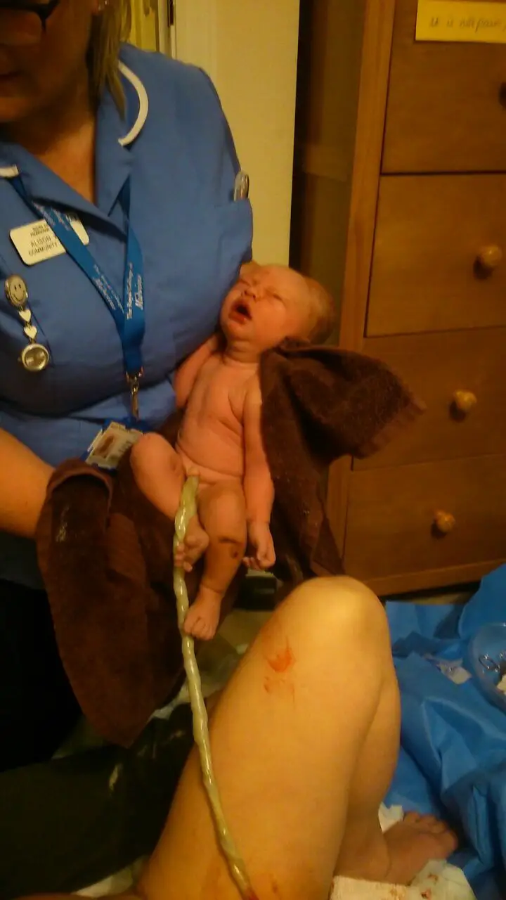 HBAC Baby with umbilical cord attached