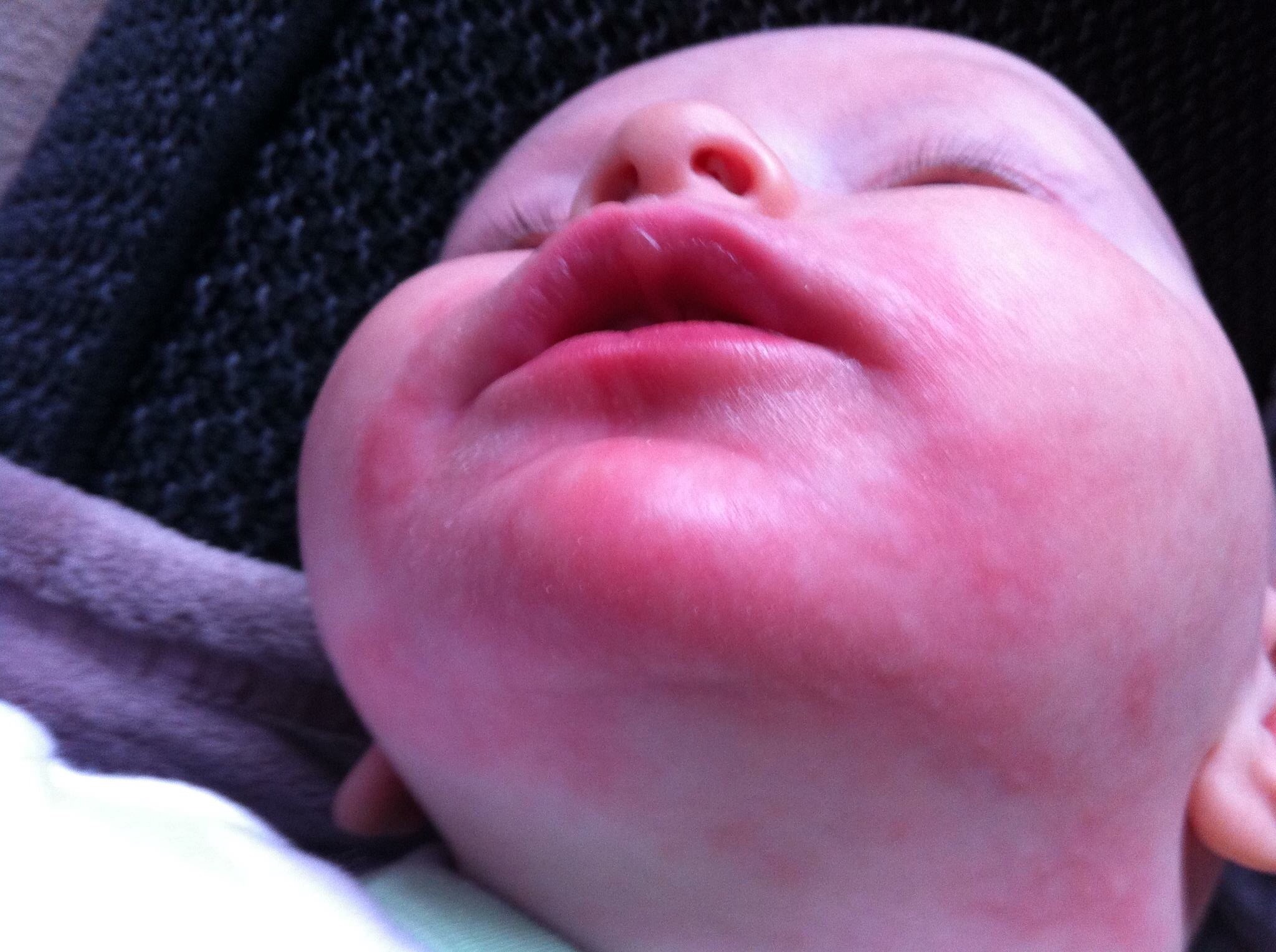 cmpa allergic reaction on a baby - swollen face covered in red hives, looks scalded 