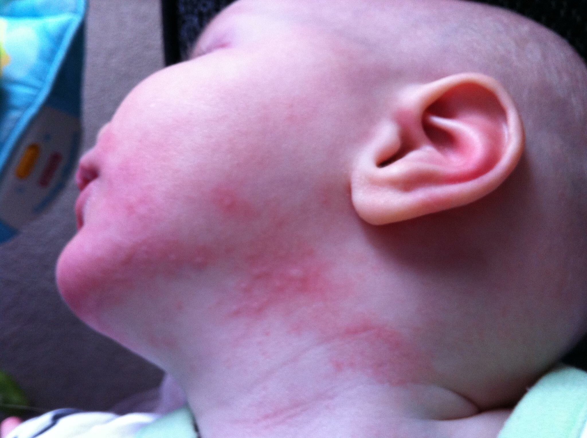 Allergic reaction on CMPA baby - hives and redness on a baby's neck