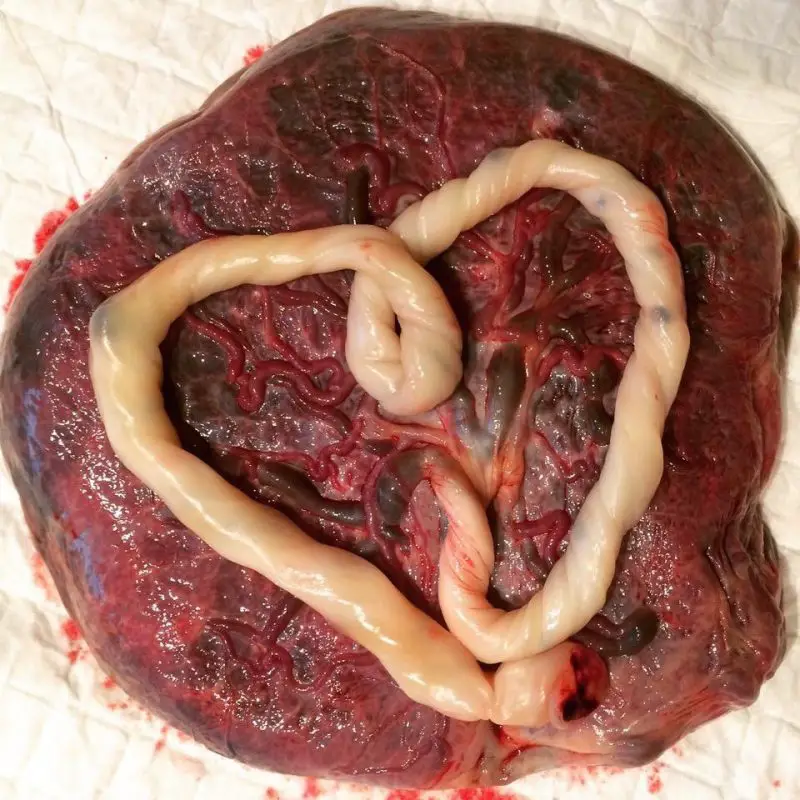 How and why I consumed my placenta